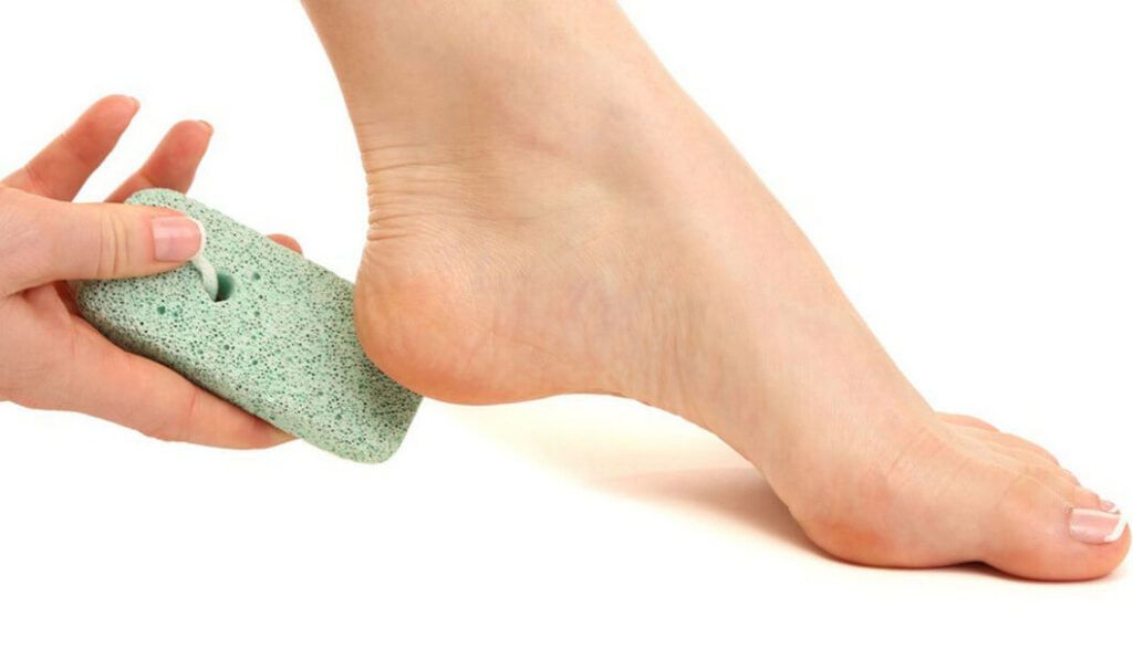 home treatments for cracked heels