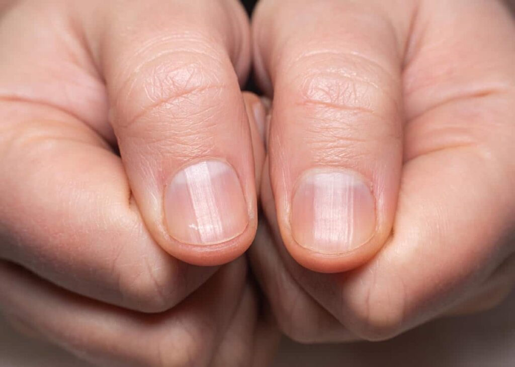 how do you fix brittle nails