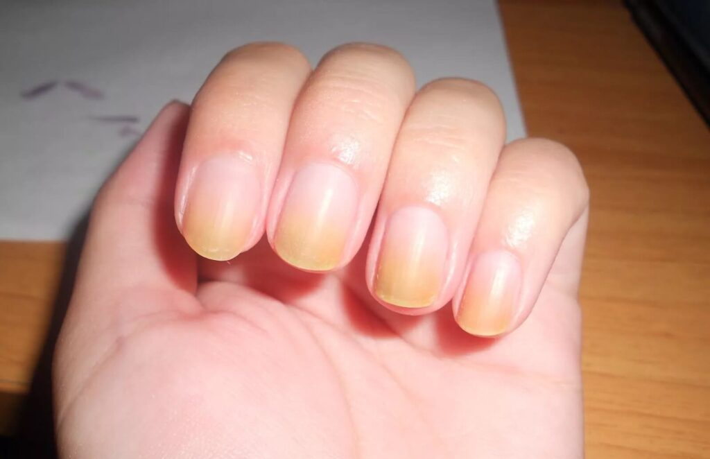 nails discoloration